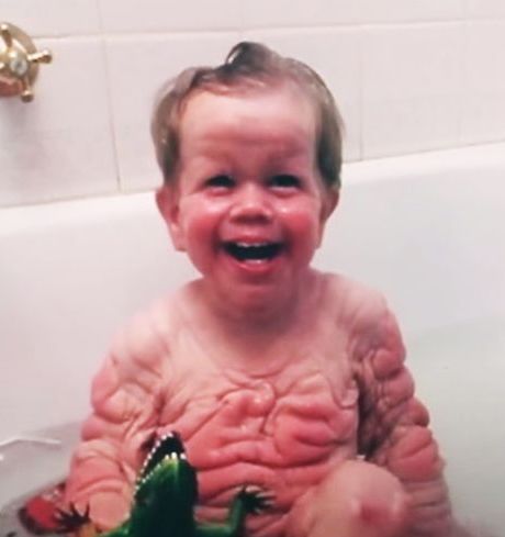 Baby Born With Enough Skin For A 5-Year-Old, Try Not To Shed A Tear When You See Him Now.