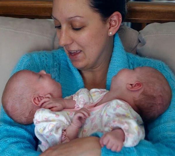 A heartwarming story about Siamese twins who had surgery when they were just 6 months old!🥺But now they are so hot and attractive girls from whom you cannot take your eyes off