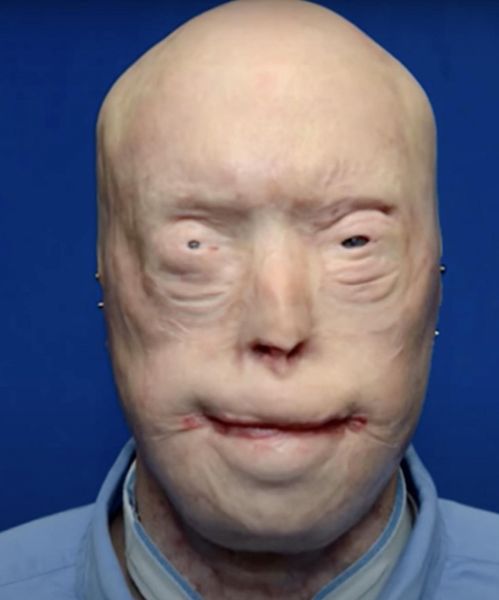 He suffered devastating burns when he tried to rescue a woman trapped in a fire. For years, he was terrified to show his face to the world, and wore caps, sunglasses and prosthetic ears in public. A few years ago, Patrick got the most extensive face transplant ever. I was not ready for how he looks now, and you won’t be either.