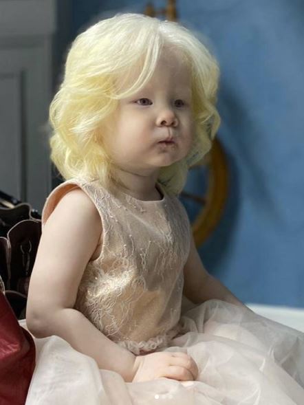 Albino girl stuns the world with her looks – just wait until you see her sister.