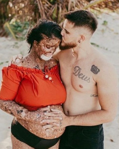 She was bullied by people who didn’t understand her condition – they called her rude names & said such as “monster” & ”zombie”. 😢💔 But her husband has the perfect response to haters.