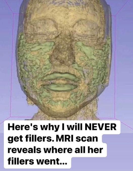 Doctor Reveals: MRI Scan Of The Face Of A 33-Year-Old Woman Reveals Where All Of Her Filler Went