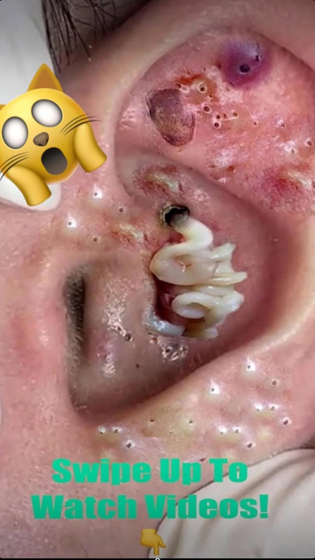 An enormous blackhead in the ear!