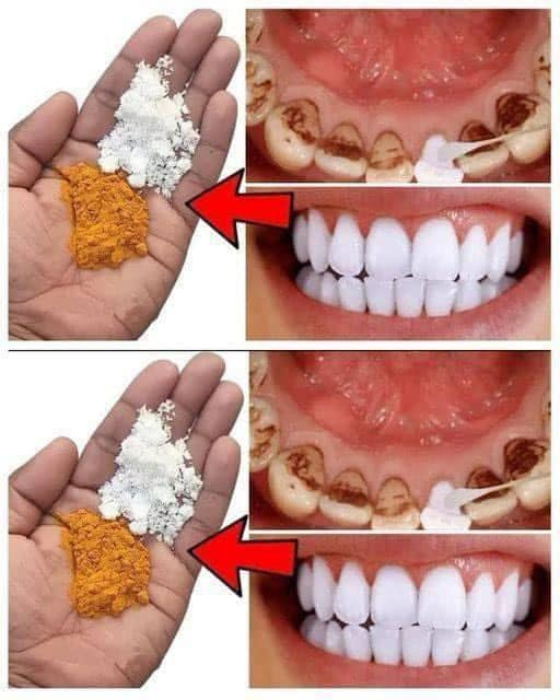 Teeth whitening in just 2 minutes – turning yellow and accumulated tartar into milk-like white and shiny…Details in the first comment👇👇