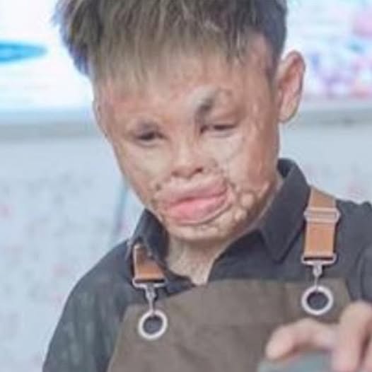 As a toddler, he was horrifically burned when he fell into a wood stove. Bullied and outcast, this brave young man was so ashamed of his looks that he stayed inside his home for 2 years. Yet as time passed, he was able to transform his life in the most beautiful way. Just wait until you see him now Check first comment for the story👇👇👇