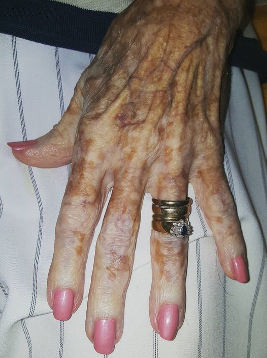 Nurse takes photo of old lady’s hand – then sees detail in the picture that has the internet exploding…. Check comments 👇🏻👀