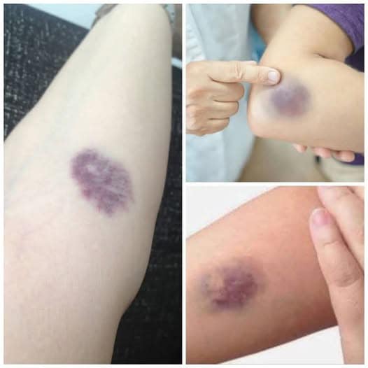 ⚠️ BE CAREFUL, if you get these bruises on your body, it means you have…Details in the first comment👇👇