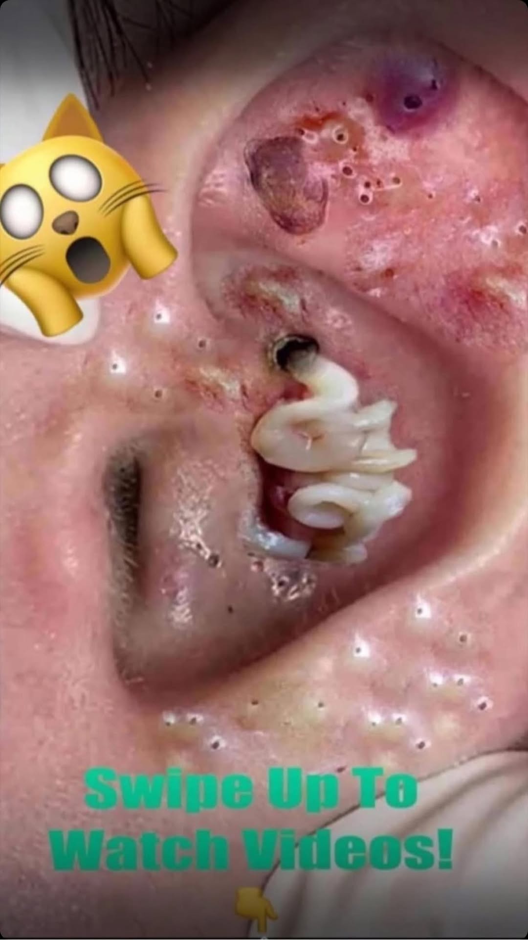 An enormous blackhead in the ear!?