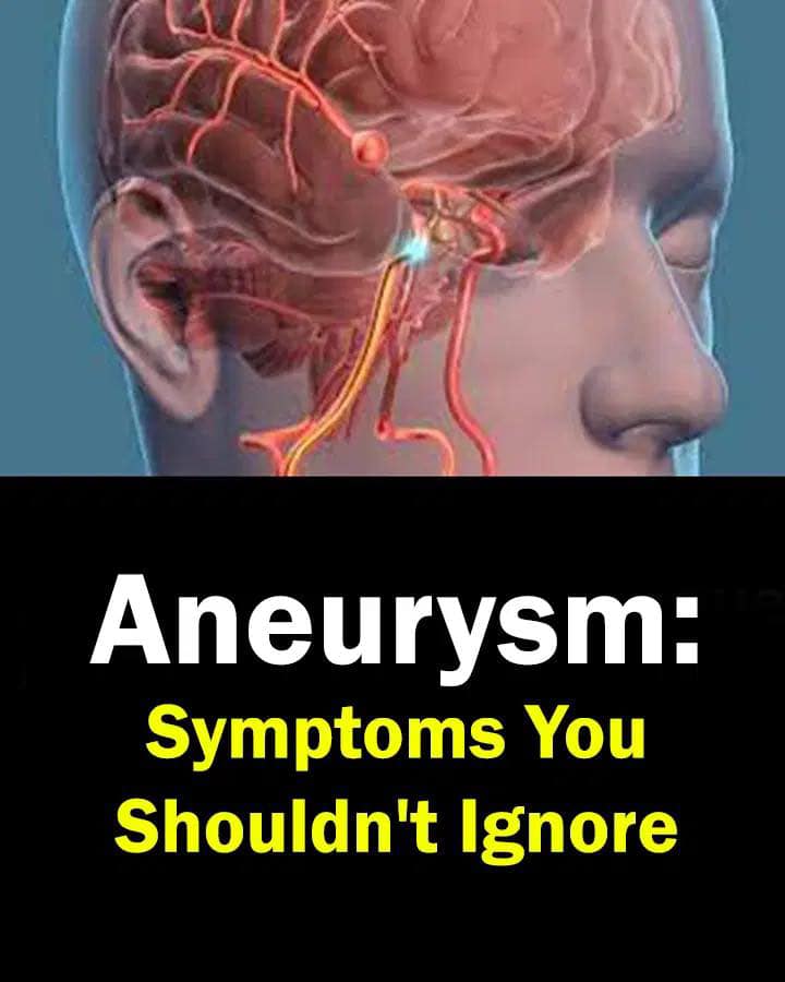 Aneurysm: Signs You Shouldn’t Ignore…..see more in (c.o.m.m.e.n.t ).👇⬇️